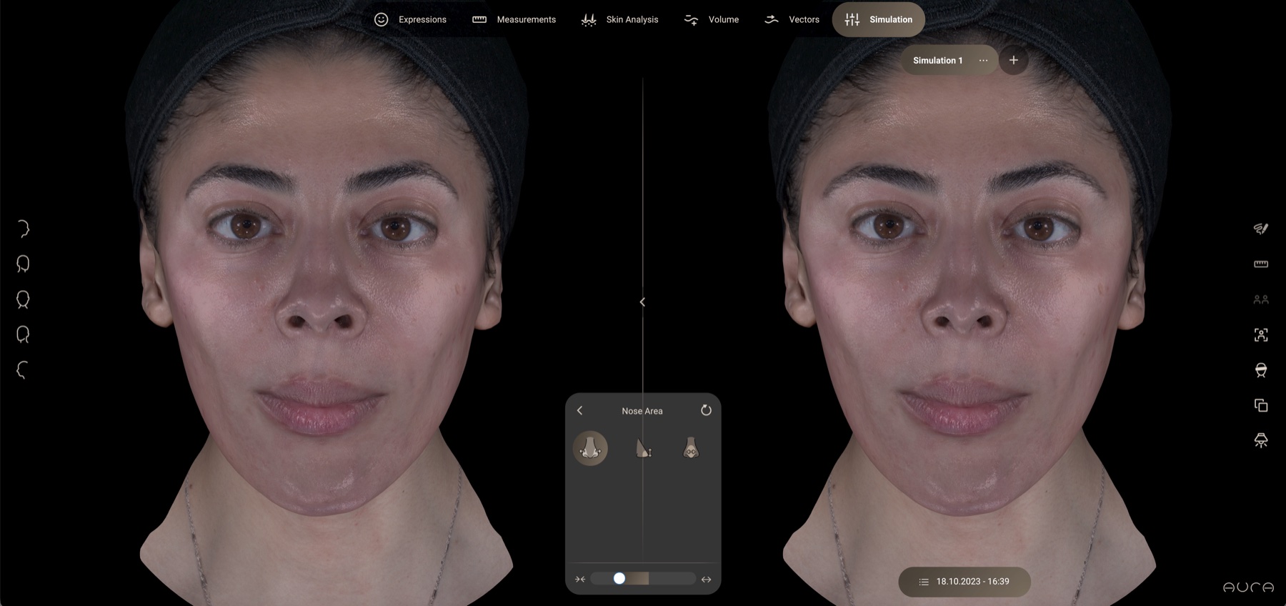 Aura treatment simulation view: 3D projection of potential outcomes